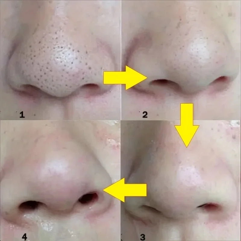 ClearSkin Blackhead Removal Strips