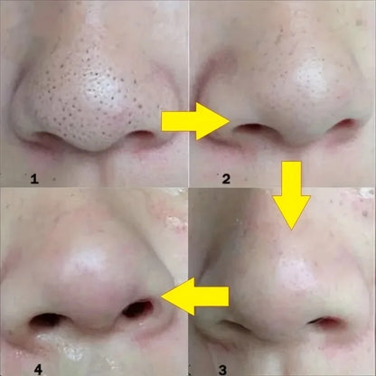 ClearSkin Blackhead Removal Strips